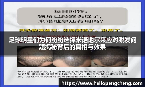 足球明星们为何纷纷选择米诺地尔来应对脱发问题揭秘背后的真相与效果